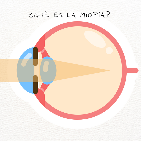 ¿Qué es la miopía y cómo se puede corregir?